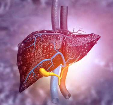 Are you a cirrhotic? When should you consider liver transplant?