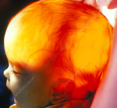 Treating Hydrocephalus in Adults
