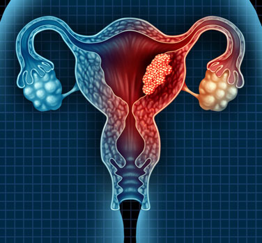 If You Have Endometrial Cancer